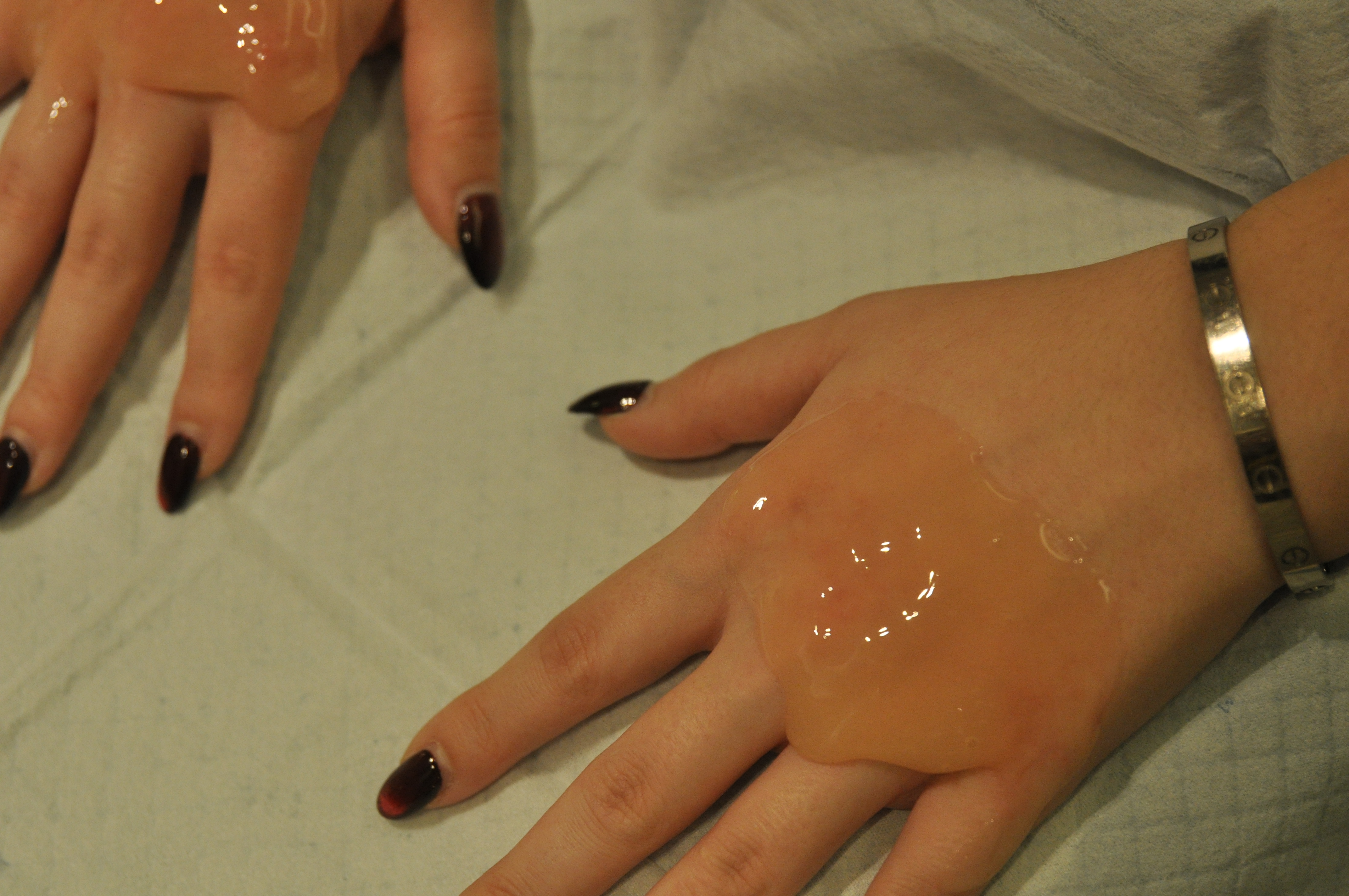 carboxytherapy applied on hands to treat eczema