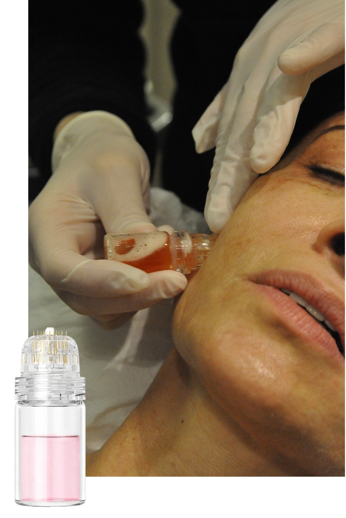 Close-up of a microfusion skincare treatment in progress, with a gloved provider applying a microneedling or infusion device containing a serum to a patient’s cheek, while a serum vial is shown alongside the treatment.