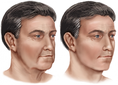 Hirmand_maleFaceLift_2.jpg