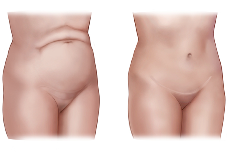 Abdominoplasty.png