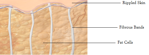 Cellulite Diagram.png